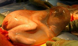  معجزه «پرده جنینی» در ترمیم زخم‌ها و سوختگی‌ها/ دستاوردی جدید در جراحی‌های چشم  