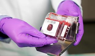 ذخیره سازی بیش از 5 میلیون واحد خون بندناف در بانک های جهانی 